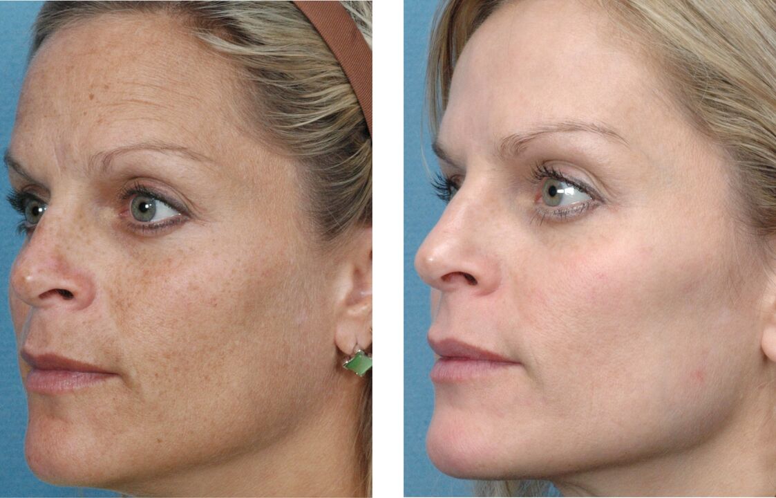 before and after skin rejuvenation photo 1