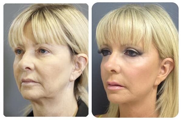 before and after skin rejuvenation with photo firming 2