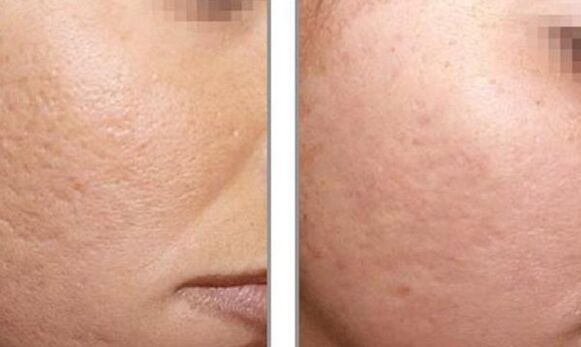 photos before and after laser rejuvenation