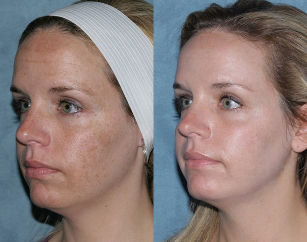 Before and after Photos of facial rejuvenation