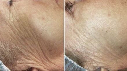 before and after laser skin rejuvenation