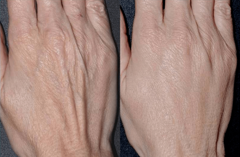 contour plastic, hand rejuvenation photo 2 before and after