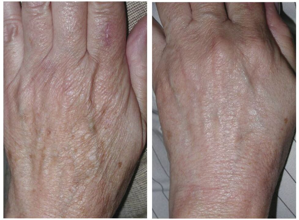 laser rejuvenation of the hands before and after photos